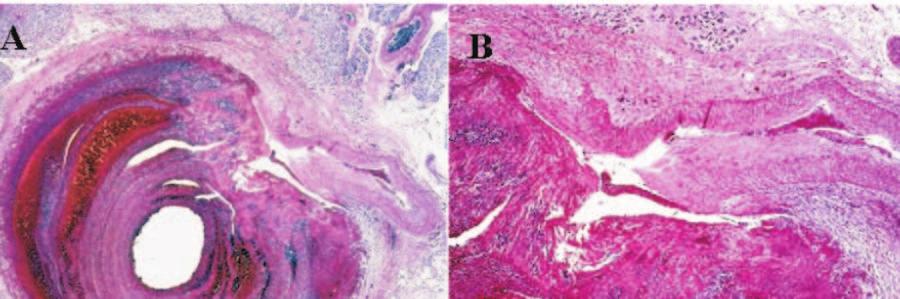 Figura 9 - Diagnóstico histopatológico: arterite sarcoídica necrotizante - A) comprometimento de artérias de médio calibre; B) granulomas sarcoídicos com necrose; C)