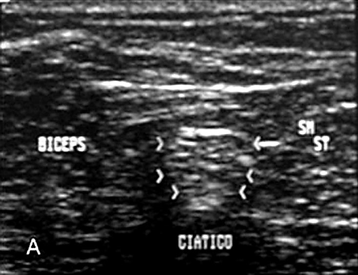 O nervo ciático é visto como uma estrutura hiperecóica, superficial ao fêmur e lateral à artéria poplítea 33 (Figura 12).