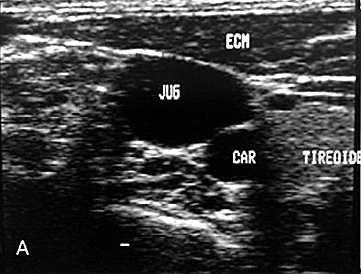 é inserida sem a monitorazação ultrassonográfica; 2) técnica mão única, em que o mesmo profissional que localiza a veia central com o ultrassom insere a agulha visualizando a