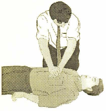 Técnicas básicas: Coloque a vítima deitada de costas em uma superfície rígida Ajoelhe-se ao seu lado Com os braços esticados apoie uma das mãos sobre a outra, e as duas sobre o peito do acidentado,