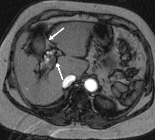 7 2.3 Interpretação das imagens Avaliações quantitativas e qualitativas dos aspectos de imagem de RM do fígado e baço foram realizadas de forma independente por dois radiologistas com experiência