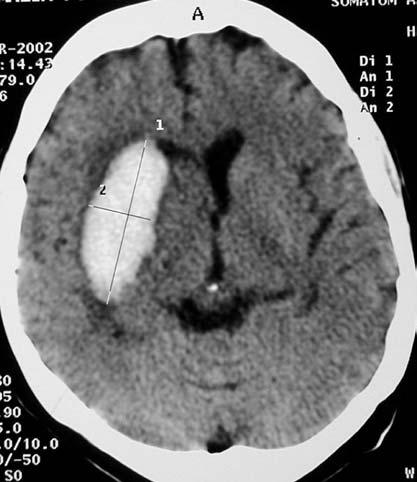 hipodenso circunjacente (edema).