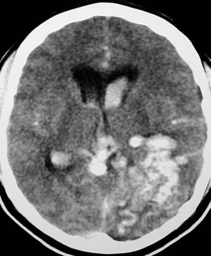 Arq Neuropsiquiatr 2004;62(3-A) 685 Fig 2.