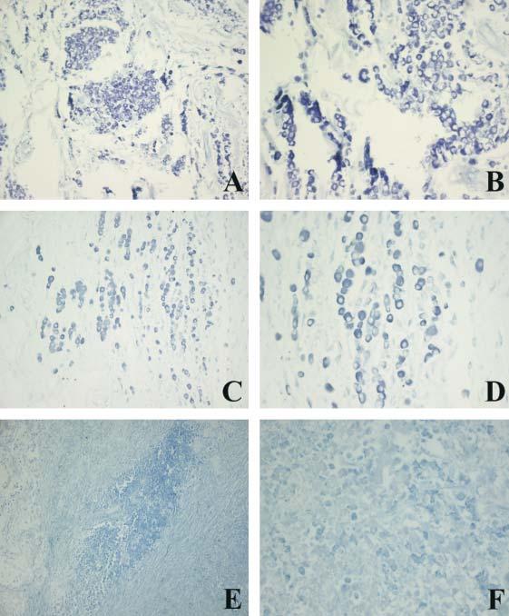 Estudo histopatológico e histoquímico de mastocitomas na região de Espírito Santo do Pinhal 271 FIGURA 3 - Mastocitoma canino corado com Azul de Toluidina ph 4,0.