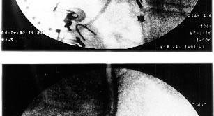 Um 1º cateter, quadripolar ou octacapolar, posicionado no átrio direito lateral com o eletrodo distal próximo à entrada do istmo (CT 1= entrada do istmo); um 2º, deflectível, com ponta de 4 ou 8mm,