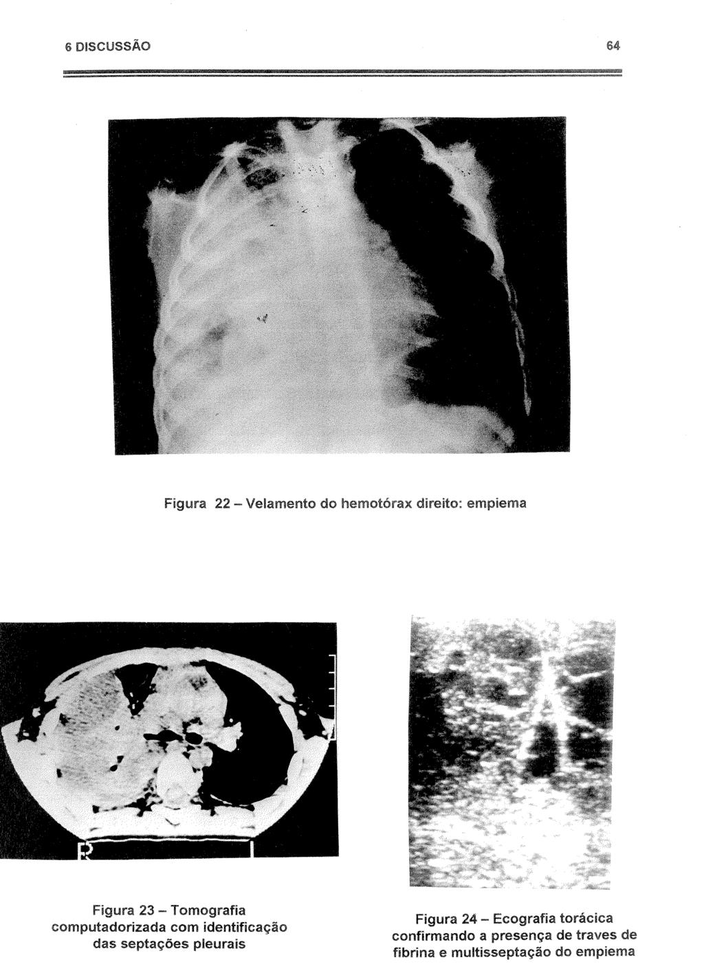 6 64 -Velamento Figura 23- Tomografia computadorizada com identificação das septações pleurais
