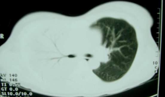 moles - mediastino pq há substituição do ar por material inflamatório com densidade t. moles. Na janela mediastínica, observam-se gânglios calcificados. Janela mediastínica Janela de pulmão 5.4.3.