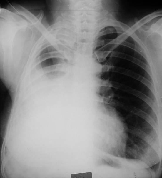 Como se visualiza o retículo pulmonar através da opacidade em toalha é uma opacidade em véu. Desvio para a direita do mediastino.