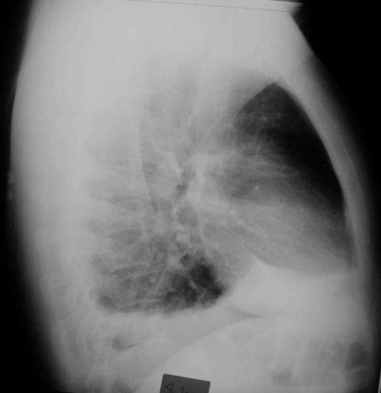 - Radiografia de perfil direito com o doente em ortostatismo.