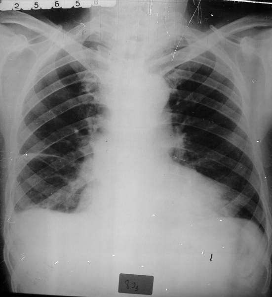 Derrame pleural direito e enquistado pleural - Opacidade em toalha homogénea, de limite mediano côncavo, que apaga o seio costofrénico direito, associada a opacidade linear transversal mais espessa