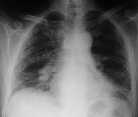 5.2.2. Fibrose pulmonar em favo - Padrão reticular formado por múltiplas imagens lineares entrelaçadas dispersas por ambos os campos pulmonares.
