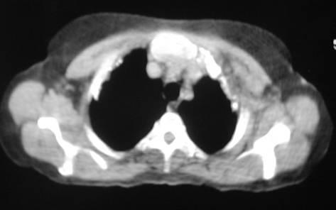 - Podem ser: De origem tuberculosa: Localizadas no folheto visceral Irregulares, densas, ovaladas (numa radiografia de perfil não apresentam a mesma morfologia) Designa-se por paquipleurite (placas