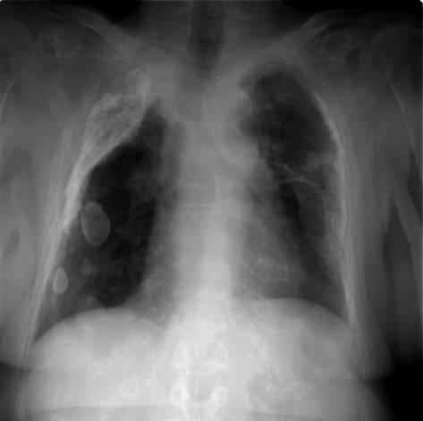 Paquipleurite Opacidades cálcicas no vértice, andares médio e inferior e à periferia do campo pulmonar direito, à esquerda só existem à periferia efeito tangencial.