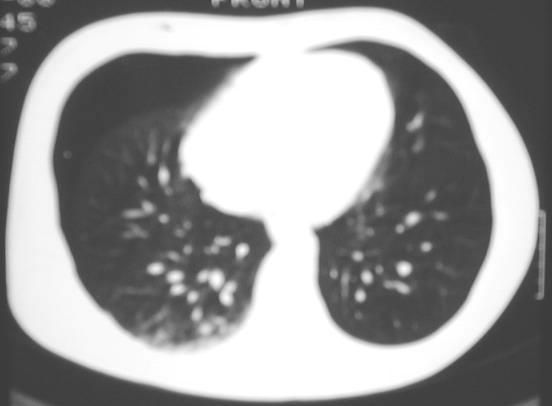 - Quando o pneumotórax é pequeno é difícil de diagnosticar: Doente colaborante radiografia em expiração profunda para aumentar a densidade do parênquima normal e o contraste com o pneumotórax.