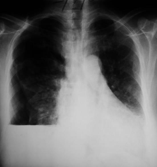 opacidade com morfologia triangular. - Desvio do mediastino para o lado contralateral (pneumotórax hipertensivo).