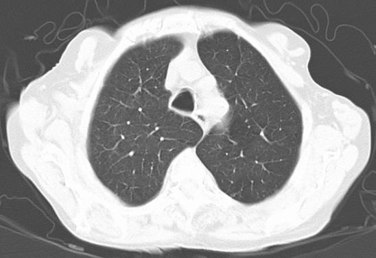 O enfisema resultante da deficiência em α-1- antitripsina afecta mais os lobos inferiores.