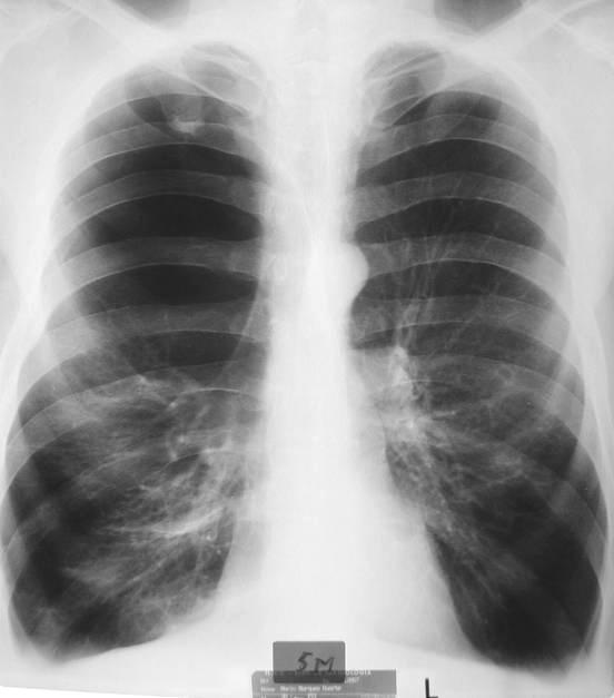 7.1.2.1. Enfisema pulmonar com bolha enfisematosa - Bolha enfisematosa no campo pulmonar direito, andar superior e médio, traduzida por ausência localizada do retículo, relativamente bem delimitada.