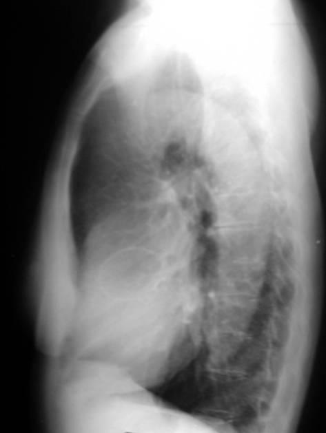 - Não se observam outras alterações pulmonares. NOTA O pneumatocelo está associado a prévia infecção pulmonar.