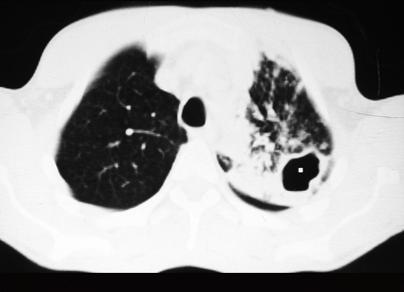 3. Coexistência de alterações enfisematosas 7.1.5. Cavitações hipertransparência localizada 7.1.5.1. Cavitação tuberculosa - Cavidade aérea rodeada por área de densificação do parênquima pulmonar do lobo superior esquerdo.