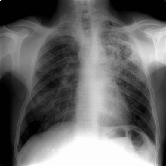 - O aumento de densidade pulmonar a rodear a cavidade é resultado de consolidação pulmonar heterogénea, limites anteriores mal definidos e limite posterior bem definido.