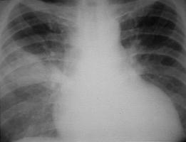 Desvios: Por colapso pulmonar Por efeito de massa (derrame pleural,