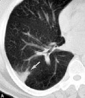 Alargamentos: Massas Mediastínicas (Aumento das cavidades, Tumor,