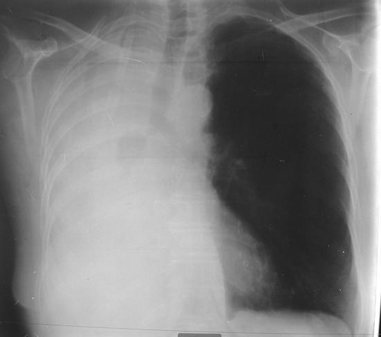 8.1. DESVIO DO MEDIASTINO 8.1.1. Colapso obstrutivo pulmonar direito por neoplasia brônquica central - Opacidade em toalha em toda a altura do CP direito, homogénea, condicionando o sinal de silhueta