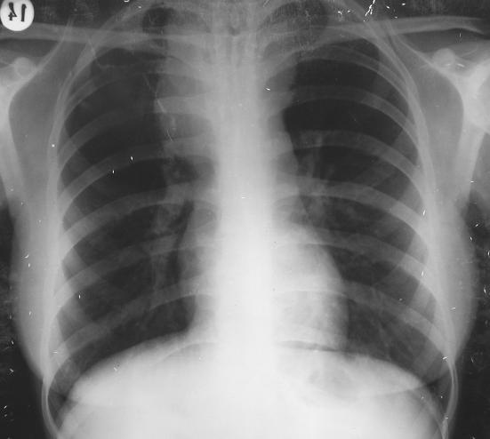 8.2.2. Adenopatias mediastinicas por linfoma - Alargamento do mediastino superior bilateral, com opacidade de tecidos homogénea, limites bem definidos em relação ao parênquima pulmonar e contorno