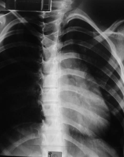 8.3. FALSOS DESVIOS E/OU ALARGAMENTOS MEDIASTÍNICOS Falso alargamento do mediastino: - Aumento do índice cardio-torácico - Incidência AP e PA em decúbito dorsal (pois aumenta a pressão do diafragma