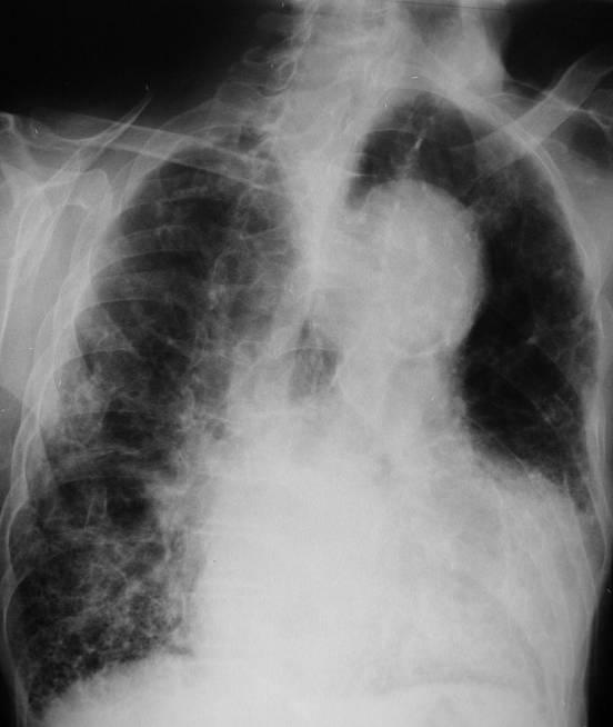 8.3.2. Fibrose pulmonar e cardiomegália - Sinais de escoliose dorsal de convexidade direita (conduz a aparente rotação do indivíduo para a esquerda).