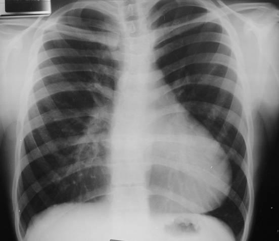 - Deformação da silhueta mediastínica com aumento do coração e acentuada hipertrofia da crossa da aorta (diâmetro superior a 5cm) cardiomegália (o andar inferior do campo pulmonar esquerdo não é