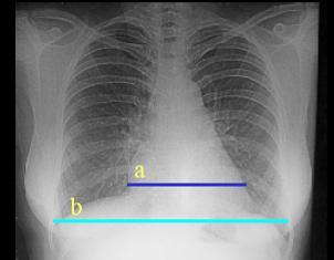 Normal < 0,5 Só pode ser medido com radiografia de incidência PA e em boa condições técnicas (bem centrada, bem inspirada).