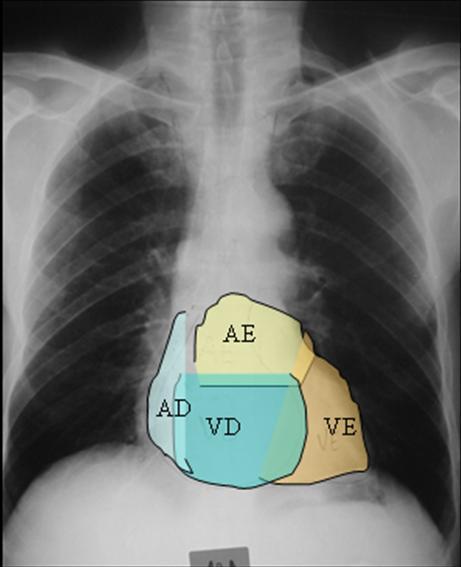 com a medular óssea por substituição de osso esponkoso por osso compacto (osteopetrose).