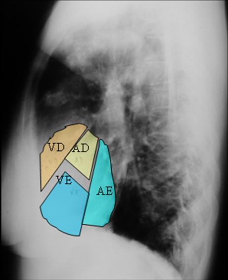 cardíaca Não se pode medir ICT: - Radiografia AP - Inspiração incorrecta - Subida da hemicúpula diafragmática (parésia do nv