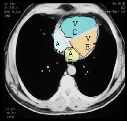 4.3.1. Insuficiência cardíaca crónica - Acentuação do retículo pulmonar.