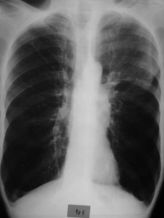 falsamente aumentado, porque o coração na expiração está mais horizontalizado e logo a sua projecção na radiografia de frente é maior.