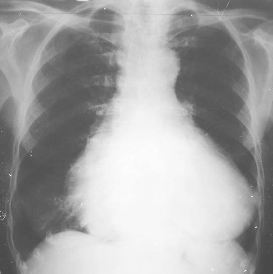 8.4.3.4. Derrame pericárdico - Ausência de acentuação do retículo pulmonar. - Hilos de dimensões normais.