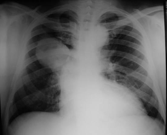 5.3.2.3. Carcinoma pulmonar cavitado Macronódulo: no andar médio do CP esquerdo heterogéneo por cavitação (excêntrica) com parede espessa e nível HA limites mal definidos Não faz sinal de silhueta