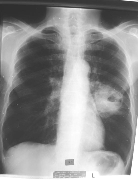 Diagnóstico diferencial abcesso pulmonar (a cavitação deve-se à presença de gás produzido por bactérias).