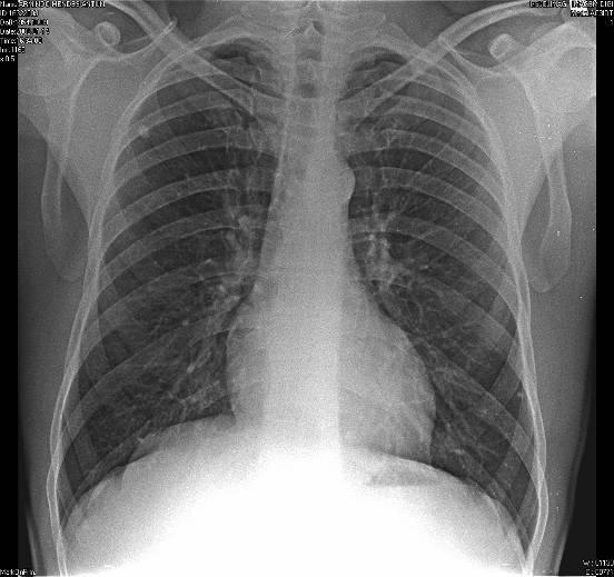 5.3.2.5. Tuberculoma (ou granuloma tubercular) - Opacidade nodular única com 2 cm no andar superior do CP direito, com contornos regulares e limites bem definidos, elevada densidade radiológica e homogéneo.