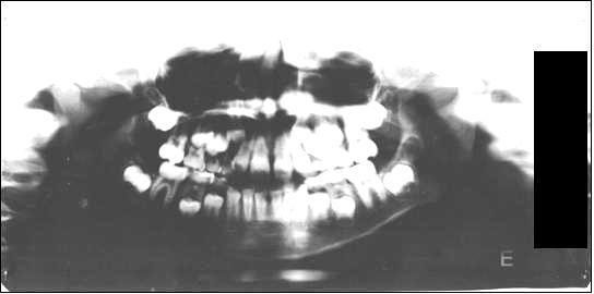 Reabsorção radicular apical Relato de caso clínico novas radiografias periapicais nem panorâmica para avaliação da quantidade e qualidade óssea. Esta terapia ortodôntica durou dois anos.