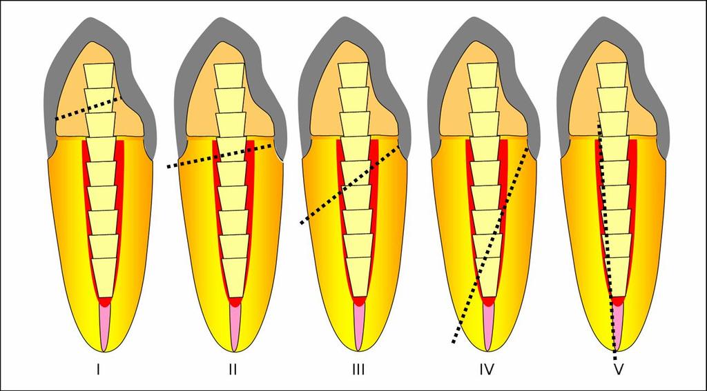 4.12. Análise do padrão de fratura Os espécimes fraturados foram analisados para determinar o padrão de fratura usando modificação do modelo de classificação proposto por Zhi-Yue & Yu-Xing (2003)