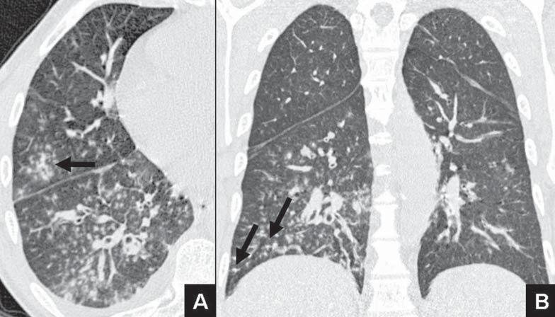 B: Reformatação no plano coronal, janela de pulmão, evidenciando múltiplas áreas de opacidades em vidro fosco, bilaterais, mais extensas nos campos superiores (setas).