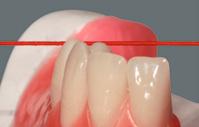 Verificação da montagem do primeiro pré-molar inferior 3 O eixo do dente está orientado perpendicularmente ao plano oclusal Figura 3: A área bucal mesial está acima do plano oclusal Figura 4: A zona