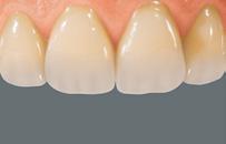 A margem incisal esbranquiçada também ajuda na excelente estética dos dentes anteriores VITA MFT.
