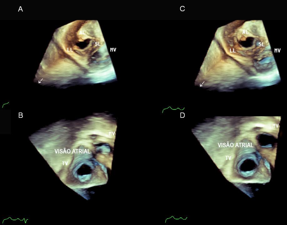 Menti et al. Síndrome carcinoide: uma visão tridimensional Relato de Caso Figura 1 Ecocardiograma transtorácico tridimensional em tempo real.