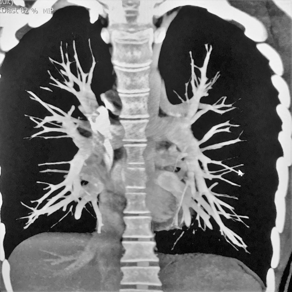 Pretto et al. Veia levoatriocardinal em adulto jovem Relato de Caso Figura 2 Angiotomografia demonstrando 4 veias pulmonares drenando no átrio esquerdo.