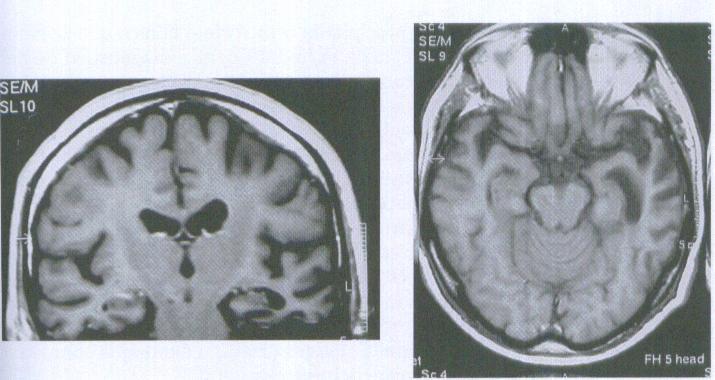 Ressonância Magnética (RM) do encéfalo (corte coronal e axial em T1) de um paciente com Demência Semântica (DS) evidenciando atrofia bitemporal assimétrica com predomínio à esquerda.