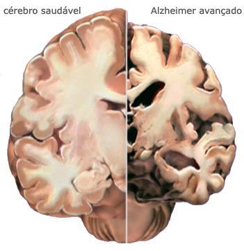 A Demência de Alzheimer responde por cerca de 60% das demências degenerativas (LOGIUDICE, 2002).
