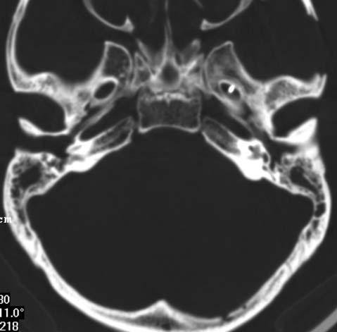 436 Arq Neuropsiquiatr 2003;61(2-B) Fig 3. Corte tomográfico axial da base do crânio em peça anatômica observando-se os dois forames ovais; presença de agulha dentro do forame oval esquerdo.